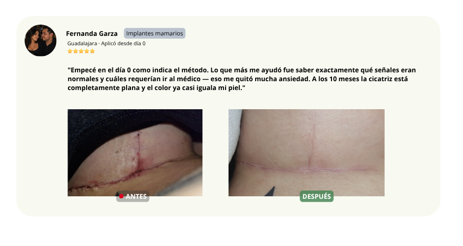 Testimonio de Fernanda Garza — Implantes mamarios